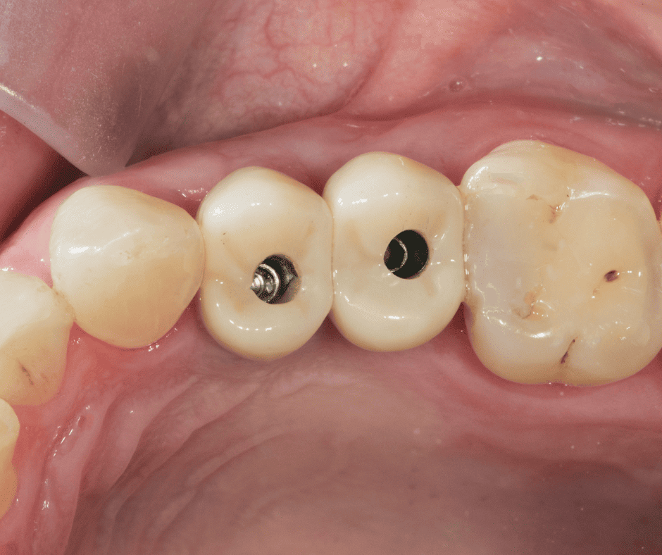 Dental Implants